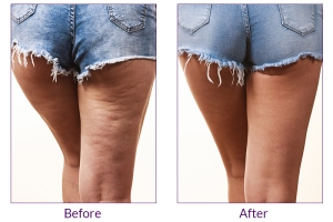 Natural Home Remedies For Cellulite Reduction!