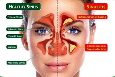 blocked sinuses